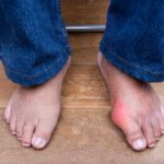 Early Signs of Bunions & How to Treat Them Before They Get Worse