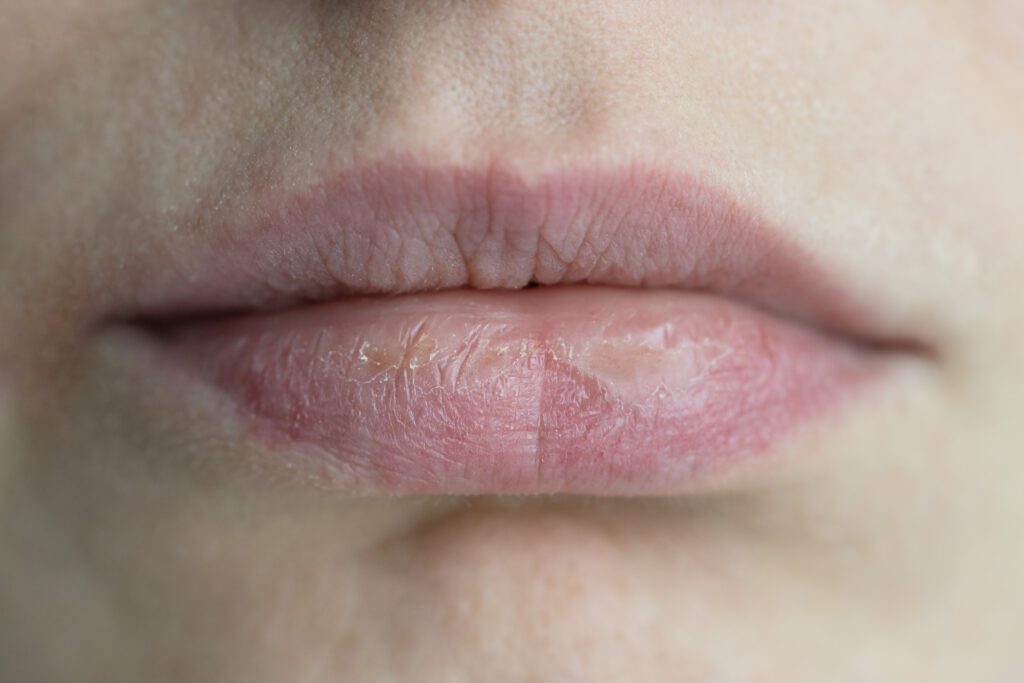 Chapped Lips vs Cold Sores