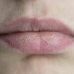 Chapped Lips vs. Cold Sore: How to Tell the Difference & When to Seek Treatment
